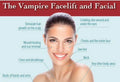 Vampire Facial $850
